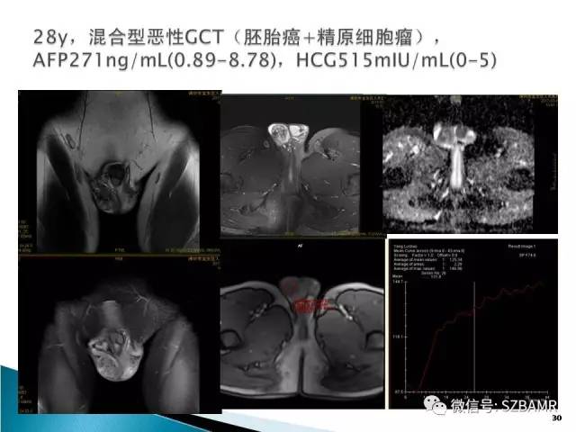 【PPT】睾丸肿瘤病变MR诊断