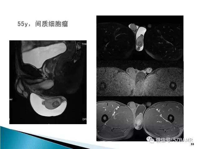 【PPT】睾丸肿瘤病变MR诊断
