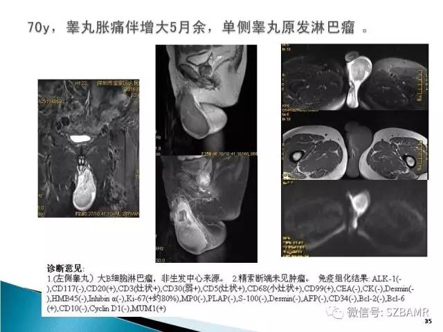 【PPT】睾丸肿瘤病变MR诊断