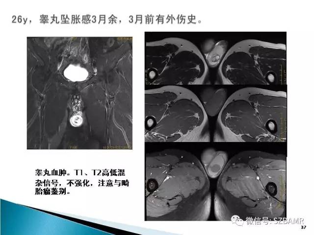 【PPT】睾丸肿瘤病变MR诊断