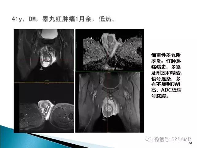 【PPT】睾丸肿瘤病变MR诊断