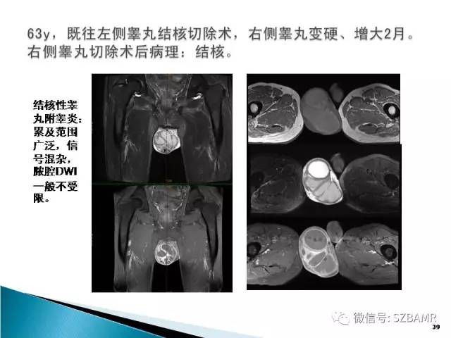 【PPT】睾丸肿瘤病变MR诊断