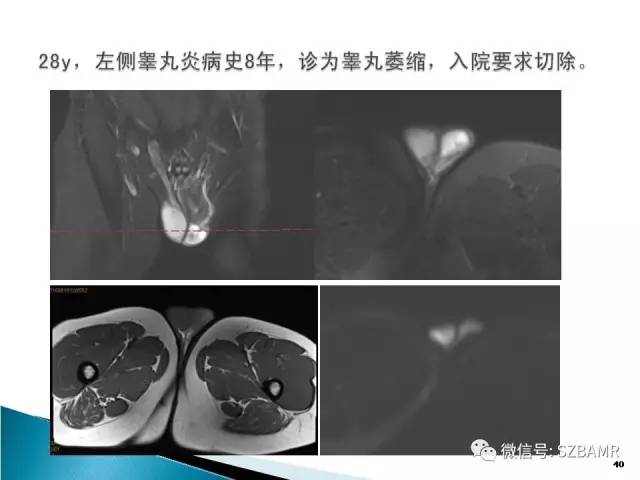 【PPT】睾丸肿瘤病变MR诊断