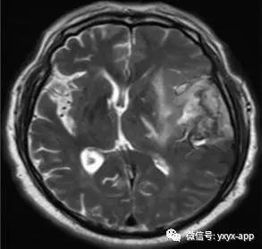 【病例】间变型少突胶质细胞瘤1例MR影像表现