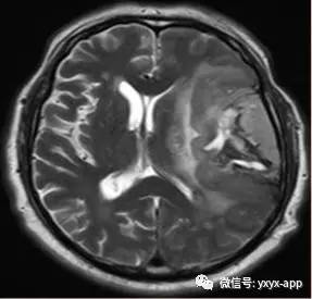 【病例】间变型少突胶质细胞瘤1例MR影像表现 【病例】间变型少突胶质细胞瘤1例MR影像表现