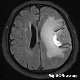 【病例】间变型少突胶质细胞瘤1例MR影像表现 【病例】间变型少突胶质细胞瘤1例MR影像表现