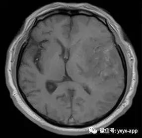 【病例】间变型少突胶质细胞瘤1例MR影像表现 【病例】间变型少突胶质细胞瘤1例MR影像表现