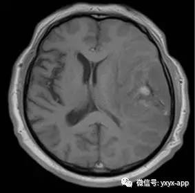 【病例】间变型少突胶质细胞瘤1例MR影像表现 【病例】间变型少突胶质细胞瘤1例MR影像表现