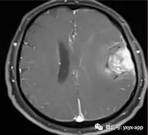【病例】间变型少突胶质细胞瘤1例MR影像表现 【病例】间变型少突胶质细胞瘤1例MR影像表现