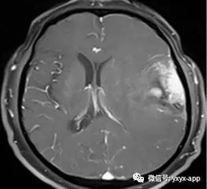 【病例】间变型少突胶质细胞瘤1例MR影像表现 【病例】间变型少突胶质细胞瘤1例MR影像表现