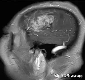 【病例】间变型少突胶质细胞瘤1例MR影像表现 【病例】间变型少突胶质细胞瘤1例MR影像表现