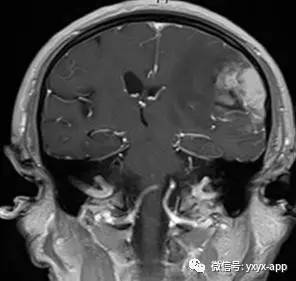 【病例】间变型少突胶质细胞瘤1例MR影像表现 【病例】间变型少突胶质细胞瘤1例MR影像表现