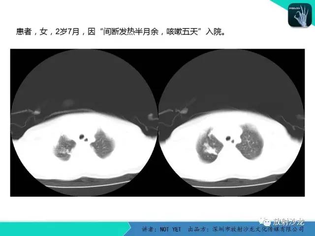 【病例】原发性肺结核1例CT影像表现
