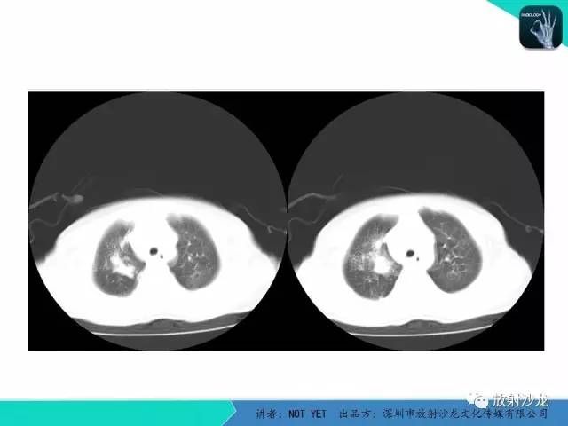【病例】原发性肺结核1例CT影像表现 【病例】原发性肺结核1例CT影像表现