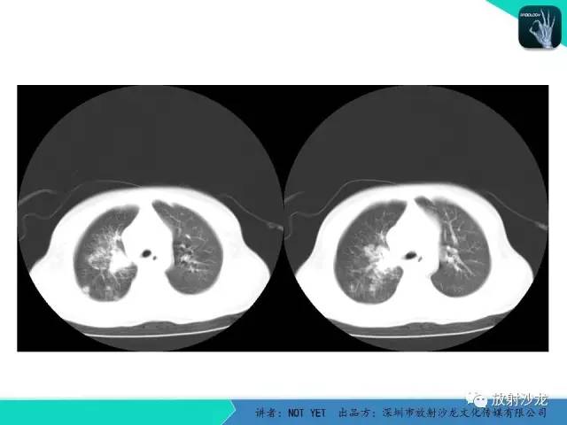 【病例】原发性肺结核1例CT影像表现 【病例】原发性肺结核1例CT影像表现