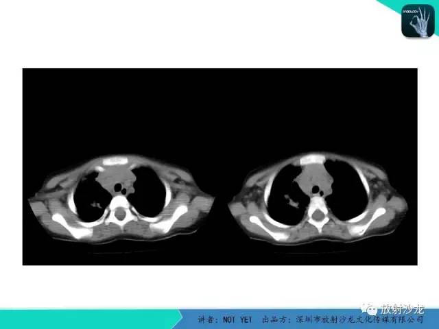 【病例】原发性肺结核1例CT影像表现 【病例】原发性肺结核1例CT影像表现