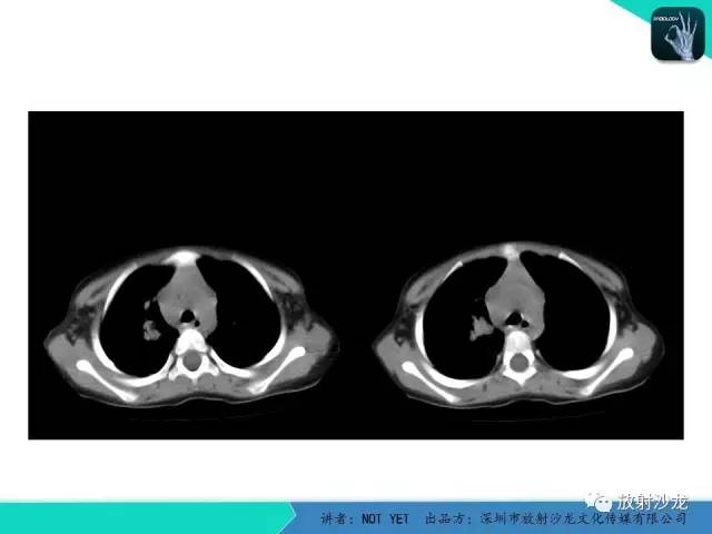 【病例】原发性肺结核1例CT影像表现 【病例】原发性肺结核1例CT影像表现