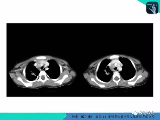 【病例】原发性肺结核1例CT影像表现 【病例】原发性肺结核1例CT影像表现