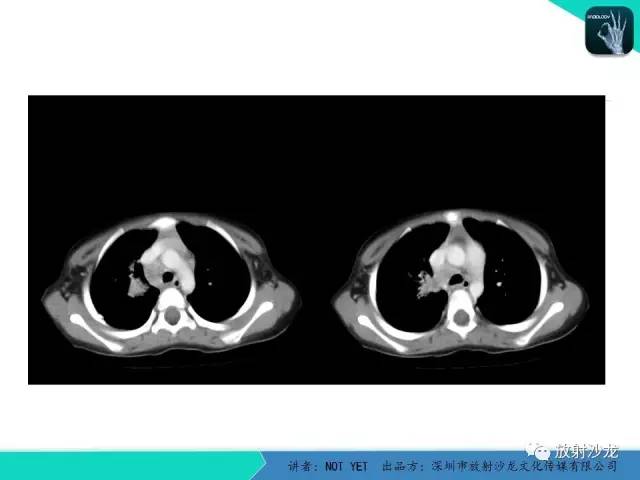 【病例】原发性肺结核1例CT影像表现 【病例】原发性肺结核1例CT影像表现