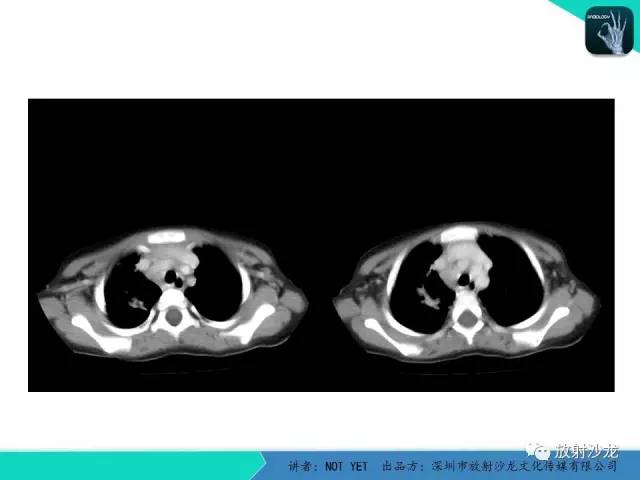 【病例】原发性肺结核1例CT影像表现 【病例】原发性肺结核1例CT影像表现
