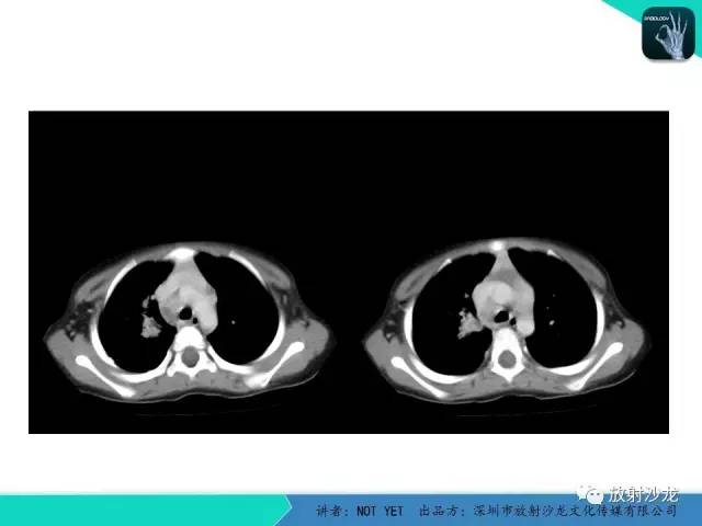 【病例】原发性肺结核1例CT影像表现 【病例】原发性肺结核1例CT影像表现