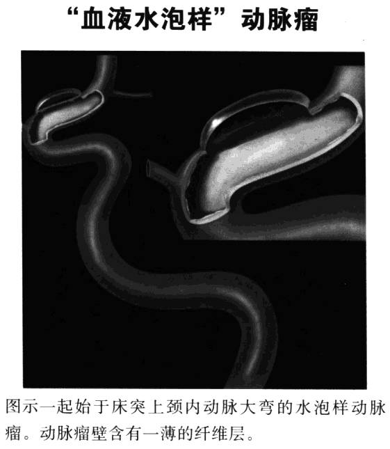 "血液水泡样"动脉瘤