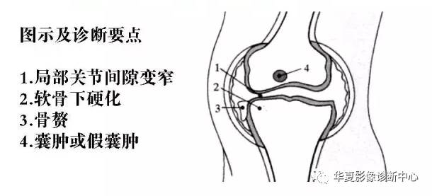 膝关节炎有五类,您能分清了么? 膝关节炎有五类,您能分清了么?