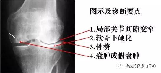 膝关节炎有五类,您能分清了么? 膝关节炎有五类,您能分清了么?