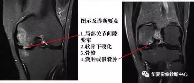 膝关节炎有五类,您能分清了么? 膝关节炎有五类,您能分清了么?