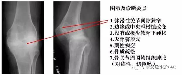 膝关节炎有五类,您能分清了么? 膝关节炎有五类,您能分清了么?