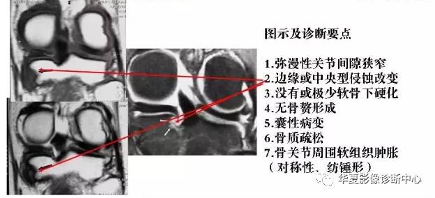 膝关节炎有五类,您能分清了么? 膝关节炎有五类,您能分清了么?