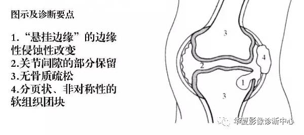 膝关节炎有五类,您能分清了么? 膝关节炎有五类,您能分清了么?