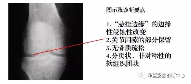 膝关节炎有五类,您能分清了么? 膝关节炎有五类,您能分清了么?