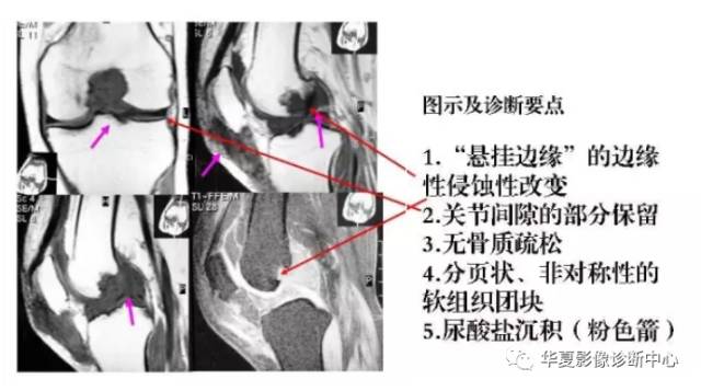膝关节炎有五类,您能分清了么? 膝关节炎有五类,您能分清了么?