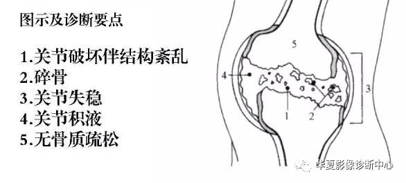 膝关节炎有五类,您能分清了么? 膝关节炎有五类,您能分清了么?