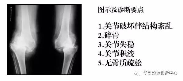 膝关节炎有五类,您能分清了么? 膝关节炎有五类,您能分清了么?