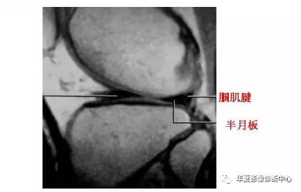 膝关节易误诊的正常解剖及伪影现象 膝关节易误诊的正常解剖及伪影现象