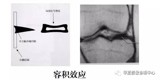膝关节易误诊的正常解剖及伪影现象 膝关节易误诊的正常解剖及伪影现象