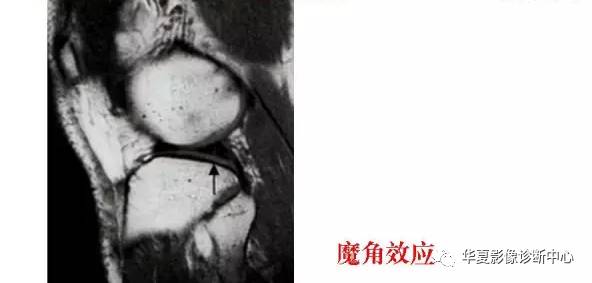 膝关节易误诊的正常解剖及伪影现象 膝关节易误诊的正常解剖及伪影现象