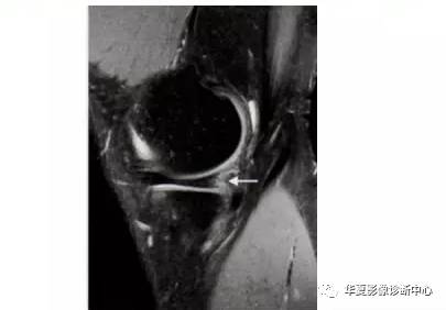 膝关节易误诊的正常解剖及伪影现象 膝关节易误诊的正常解剖及伪影现象