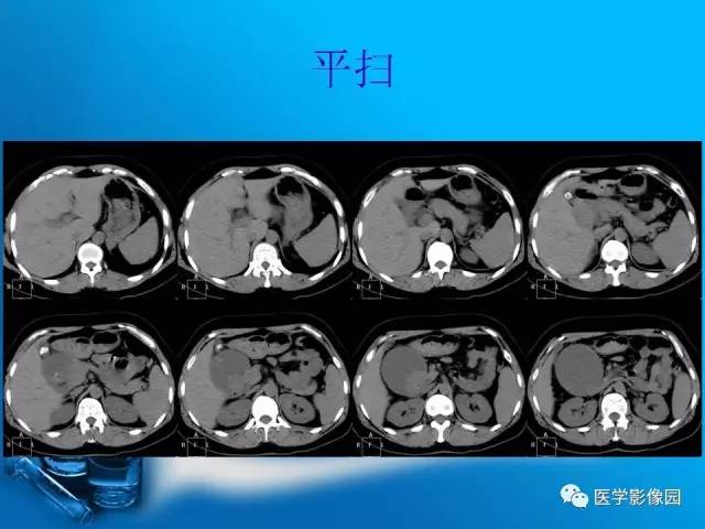 【病例】胰腺囊腺癌1例CT影像表现