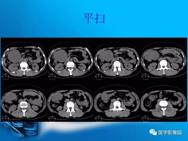 【病例】胰腺囊腺癌1例CT影像表现