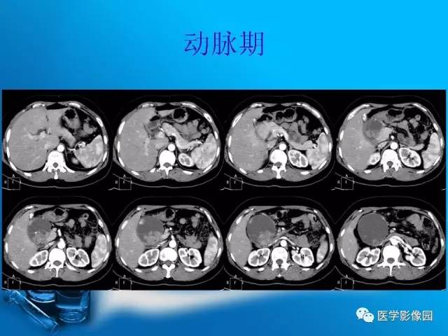 【病例】胰腺囊腺癌1例CT影像表现