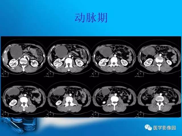 【病例】胰腺囊腺癌1例CT影像表现