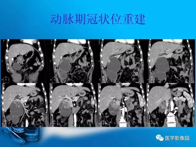 【病例】胰腺囊腺癌1例CT影像表现