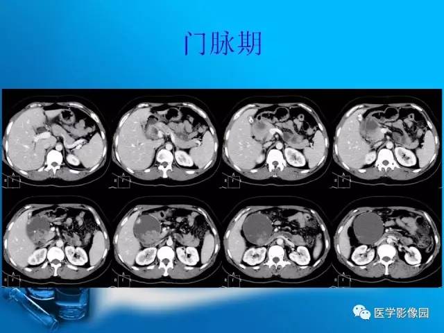 【病例】胰腺囊腺癌1例CT影像表现