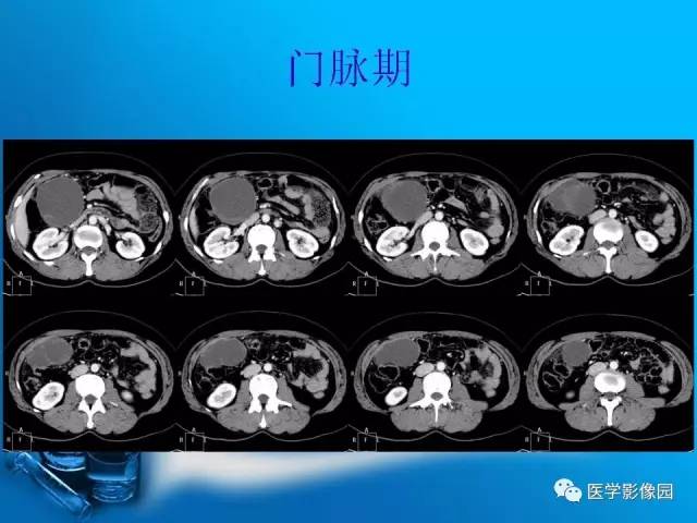 【病例】胰腺囊腺癌1例CT影像表现