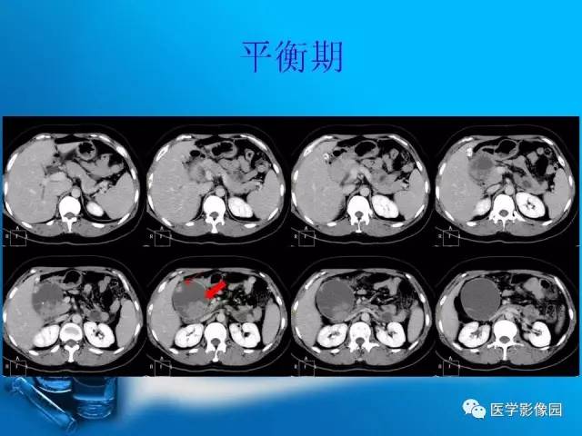 【病例】胰腺囊腺癌1例CT影像表现