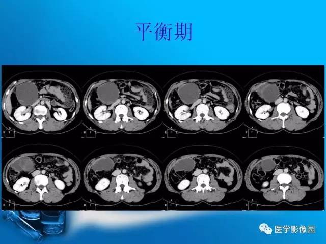 【病例】胰腺囊腺癌1例CT影像表现
