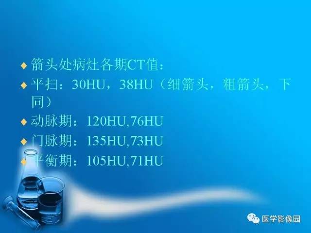 【病例】胰腺囊腺癌1例CT影像表现